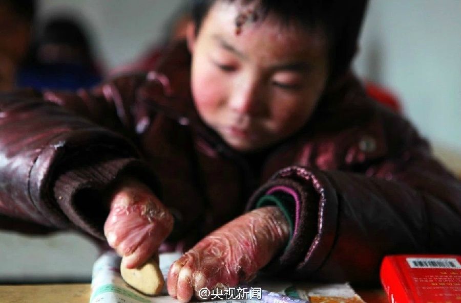 男孩皮肤一碰就破 卫生纸裹全身坚持上学 男孩皮肤一碰就破 卫生纸裹全身坚持上学